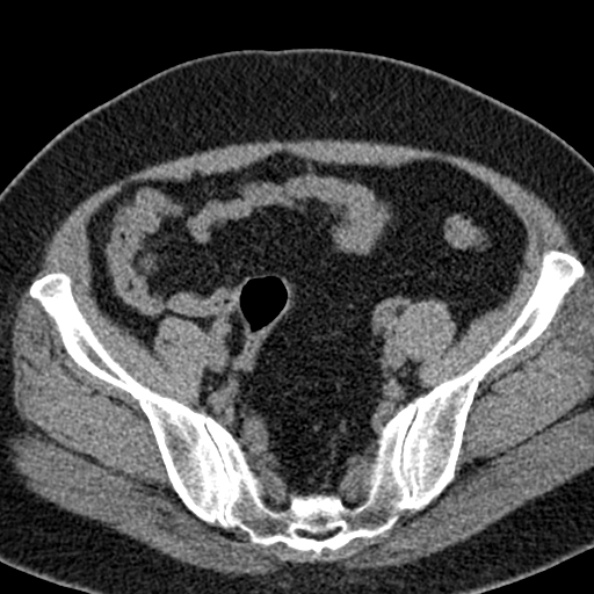 File:Nephrostomy for urosepsis (Radiopaedia 26180-26330 Axial non-contrast 51).jpg