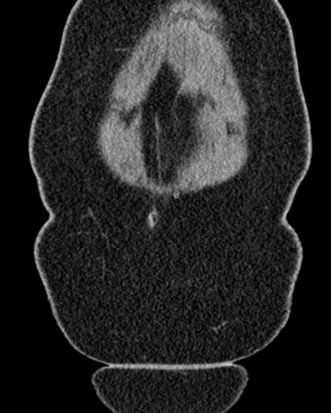 File:Nephrostomy for urosepsis (Radiopaedia 26180-26330 non-contrast 10).jpg