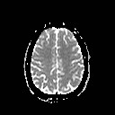 File:Neuro-Behcet's disease (Radiopaedia 21557-21505 Axial ADC 17).jpg