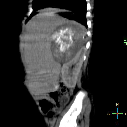File:Neuroblastoma (Radiopaedia 24751-25016 C 23).jpg