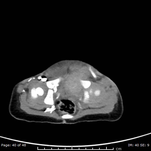 File:Neuroblastoma (Radiopaedia 41472-44355 A 40).jpg