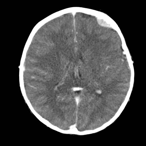File:Neuroblastoma (Radiopaedia 8176-36438 B 1).jpg