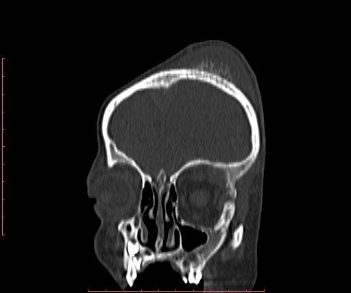 File:Neuroblastoma skull metastasis (Radiopaedia 56053-62683 Coronal bone window 7).jpg