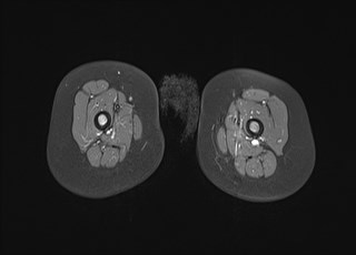 File:Neuroblastoma with bone metastases (Radiopaedia 67080-76414 Axial T1 C+ fat sat 30).jpg