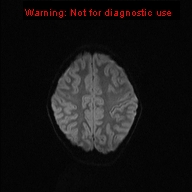 File:Neurofibromatosis type 1 with optic nerve glioma (Radiopaedia 16288-15965 Axial DWI 30).jpg