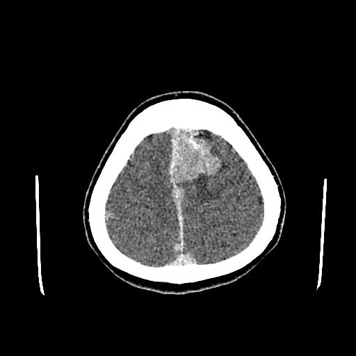 File:Neurofibromatosis type 2 (Radiopaedia 25389-25637 Axial C+ 86).jpg