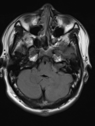 File:Neurofibromatosis type 2 (Radiopaedia 44936-48838 Axial FLAIR 5).png