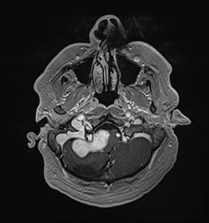 Neurofibromatosis type 2 (Radiopaedia 79097-92049 Axial T1 C+ 38).jpg