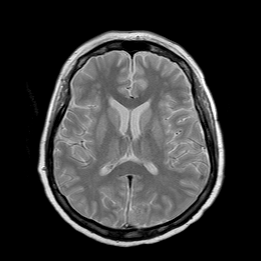File:Neurofibromatosis type 2 (Radiopaedia 8713-9518 Axial Gradient Echo 11).jpg