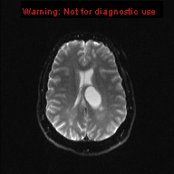File:Neuroglial cyst (Radiopaedia 10713-11184 Axial DWI 9).jpg