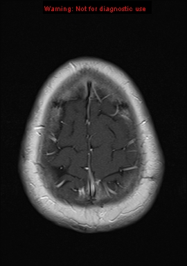 File:Neuroglial cyst (Radiopaedia 10713-11184 Axial T1 C+ 3).jpg