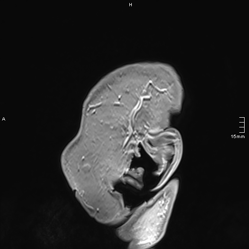 Neurosarcoidosis - involvement of the mesial temporal lobes (Radiopaedia 67429-76820 Sagittal T1 C+ 6).jpg