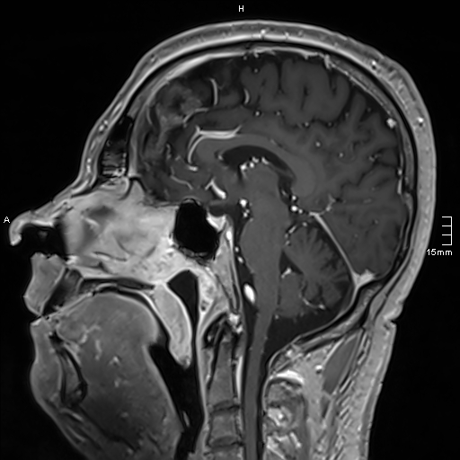 Neurosarcoidosis - involvement of the mesial temporal lobes (Radiopaedia 67429-76820 Sagittal T1 C+ 82).jpg