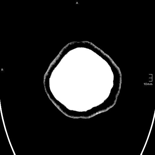 File:Neurotoxoplasmosis - concentric target sign (Radiopaedia 70644-80783 Axial non-contrast 42).jpg