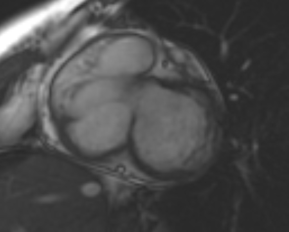 File:Non-compaction of the left ventricle (Radiopaedia 69436-79314 Short axis cine 200).jpg
