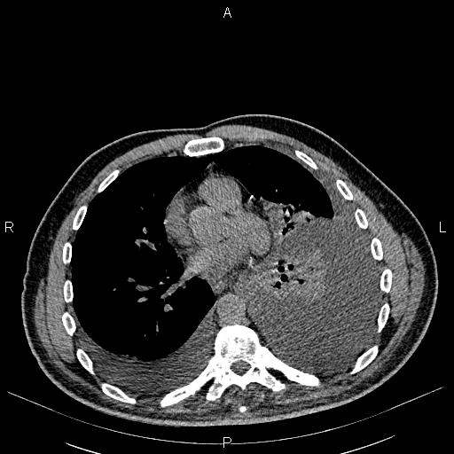 File:Non Hodgkin lymphoma in a patient with ankylosing spondylitis (Radiopaedia 84323-99621 Axial non-contrast 18).jpg