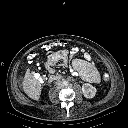 File:Non Hodgkin lymphoma in a patient with ankylosing spondylitis (Radiopaedia 84323-99621 B 43).jpg