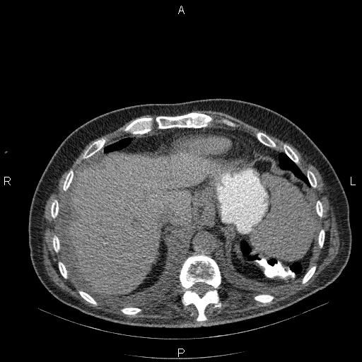 File:Non Hodgkin lymphoma in a patient with ankylosing spondylitis (Radiopaedia 84323-99624 Axial non-contrast 29).jpg
