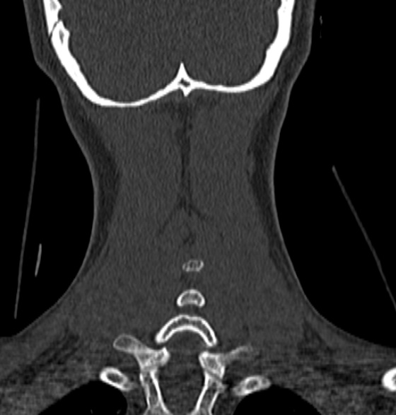 File:Normal CT cervical spine - 12-year-old (Radiopaedia 55352-61775 Coronal bone window 194).jpg