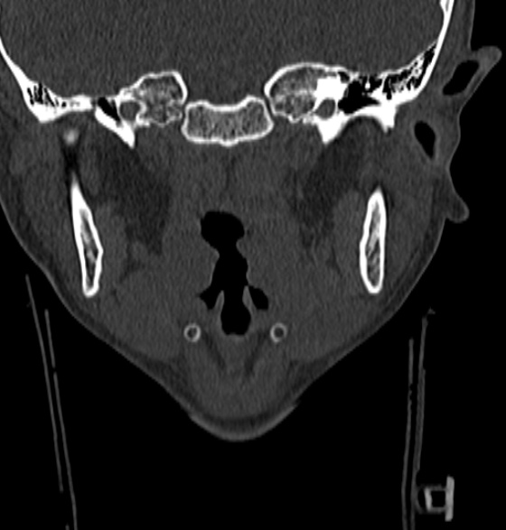 File:Normal CT cervical spine - 12-year-old (Radiopaedia 55352-61775 Coronal bone window 5).jpg