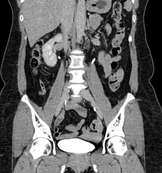 Normal CT intravenous urogram (Radiopaedia 39444-41759 A 274).jpg