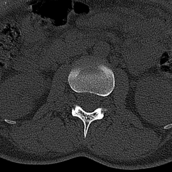 File:Normal CT lumbar spine (Radiopaedia 53981-60118 Axial bone window 26).jpg