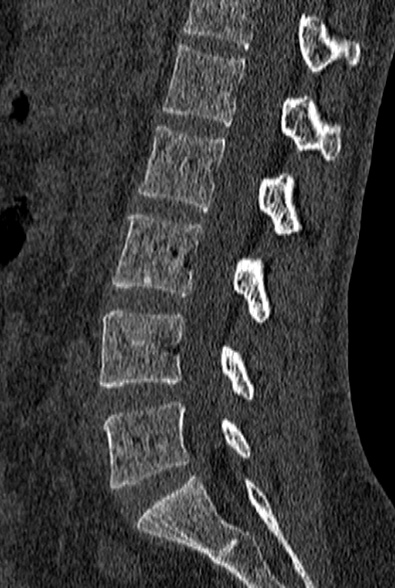 File:Normal CT lumbar spine (Radiopaedia 53981-60118 Sagittal bone window 51).jpg