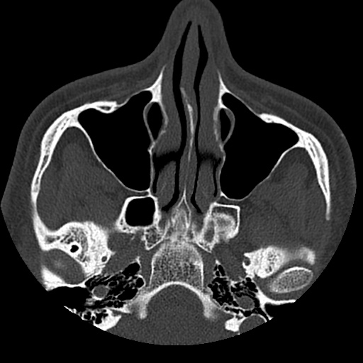 Normal CT paranasal sinuses (Radiopaedia 42286-45390 Axial bone window 73).jpg