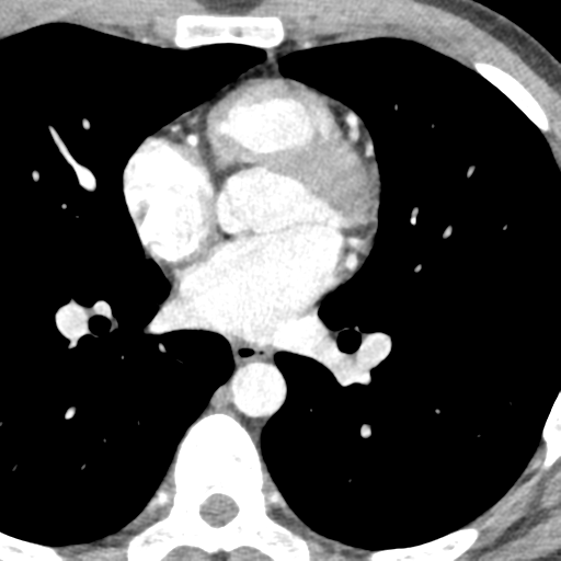 File:Normal CT pulmonary veins (pre RF ablation) (Radiopaedia 41748-44702 A 162).png