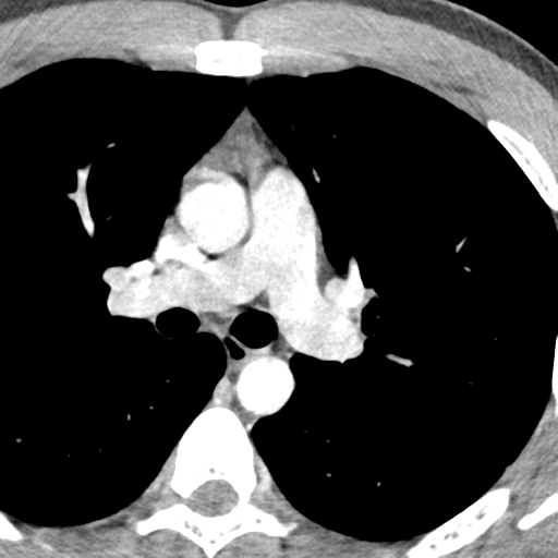 File:Normal CT pulmonary veins (pre RF ablation) (Radiopaedia 41748-44702 A 65).png