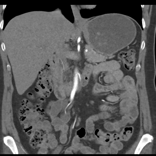 File:Normal CT renal artery angiogram (Radiopaedia 38727-40889 B 36).png