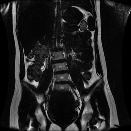 Normal MRI abdomen in pregnancy (Radiopaedia 88001-104541 N 81).jpg