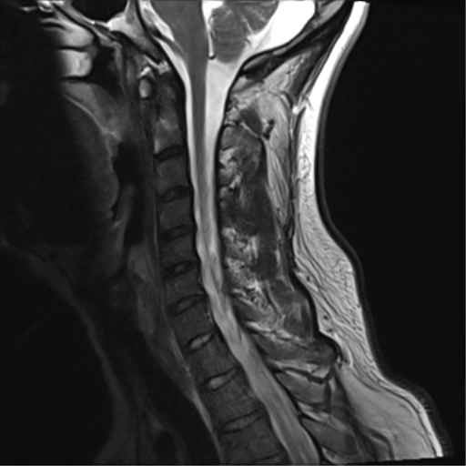 File:Normal MRI cervical spine (infection protocol) (Radiopaedia 53916-60039 Sagittal T2 10).png