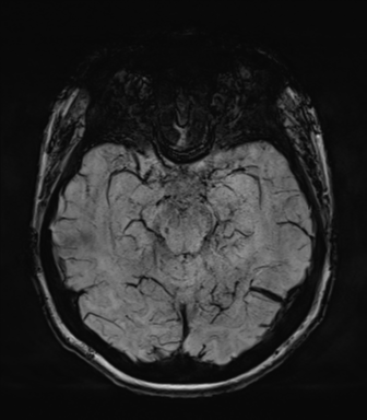 Normal MRI internal auditory canal (Radiopaedia 41613-44525 Axial SWI MIP 30).png