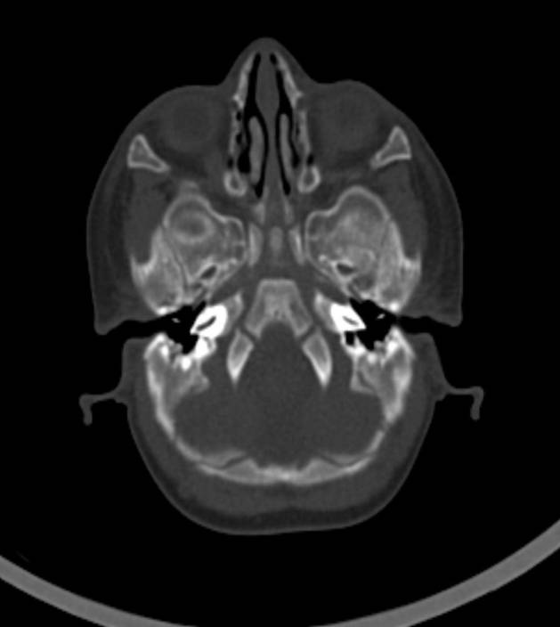 Normal brain CT - 2-month-old (Radiopaedia 53369-59350 Axial bone window 51).jpg