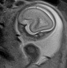 File:Normal brain fetal MRI - 22 weeks (Radiopaedia 50623-56050 Sagittal T2 Haste 18).jpg