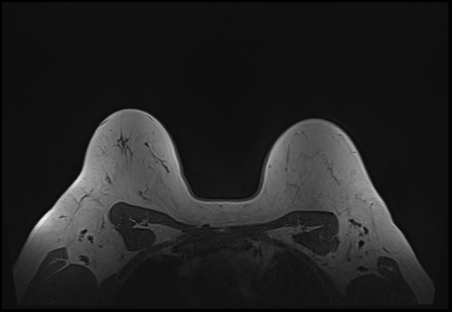 File:Normal breast MRI - dense breasts (Radiopaedia 80454-93850 Axial T1 182).jpg