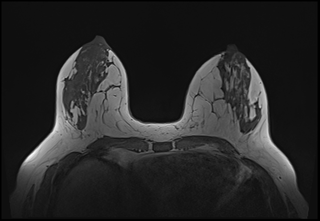 File:Normal breast MRI - dense breasts (Radiopaedia 80454-93850 Axial T1 88).jpg