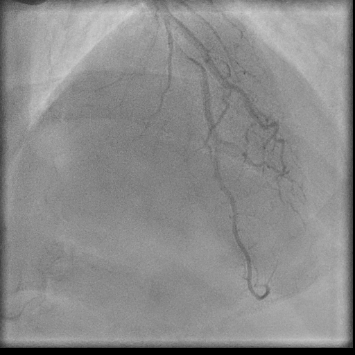 Normal coronary angiogram (DSA) (Radiopaedia 63081-71571 E 76).jpg