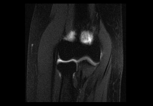 File:Normal elbow arthrograms (Radiopaedia 75550-86805 Coronal T1 fat sat 9).jpg