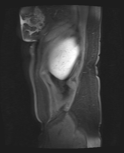 File:Normal hepatobiliary phase liver MRI (Radiopaedia 58968-66230 C 6).jpg