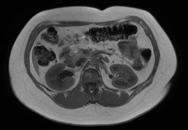 File:Normal liver MRI with Gadolinium (Radiopaedia 58913-66163 Axial T1 in-phase 13).jpg