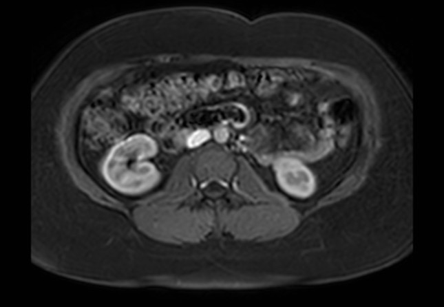 Normal liver MRI with Gadolinium (Radiopaedia 58913-66163 J 9).jpg