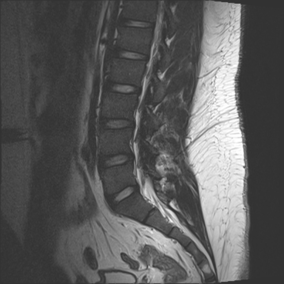 File:Normal lumbar spine MRI (Radiopaedia 47857-52609 Sagittal T2 8).jpg