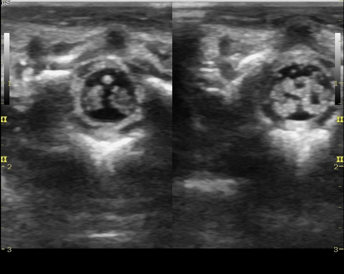 File:Normal neonatal spinal canal on ultrasound (Radiopaedia 34886-36353 Transverse 1).jpg