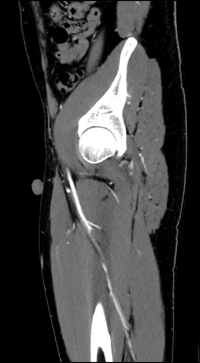 Normal pelvis CT angiogram (Radiopaedia 84966-100481 C 81).jpg