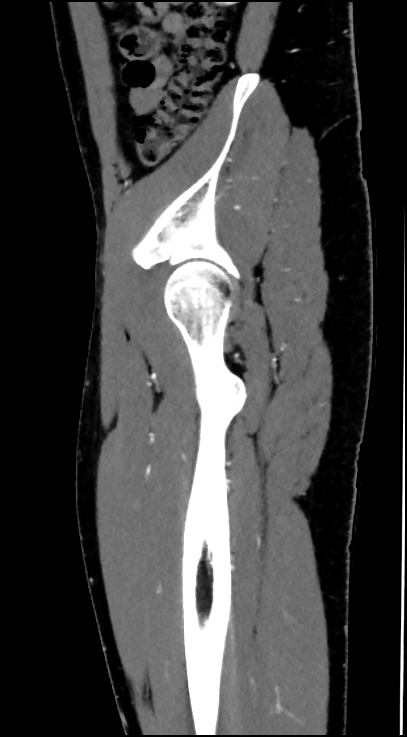 Normal pelvis CT angiogram (Radiopaedia 84966-100481 C 87).jpg