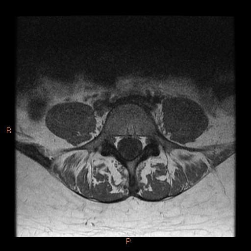 File:Normal spine MRI (Radiopaedia 77323-89408 Axial T1 19).jpg