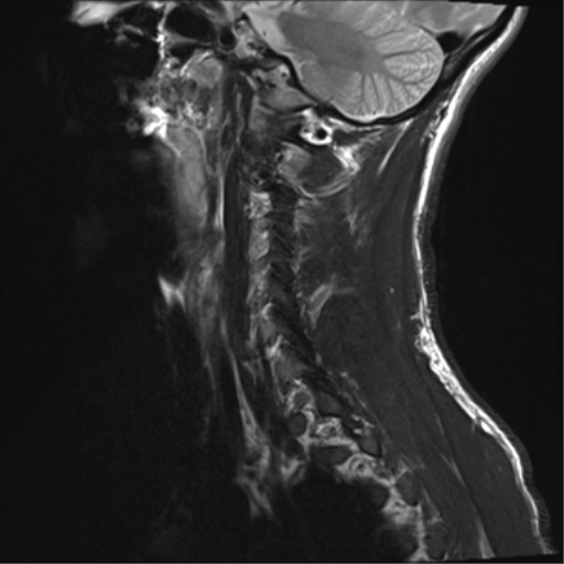 File:Normal trauma cervical spine (Radiopaedia 41017-43762 Sagittal T2 2).png