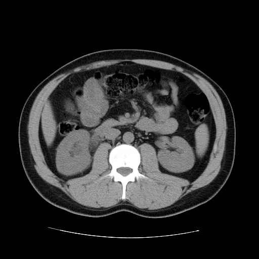 File:Obstructing ureteric calculus (Radiopaedia 18615-18514 Axial non-contrast 25).jpg